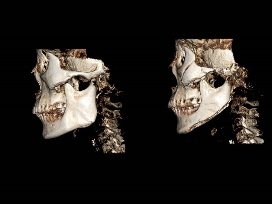 Zygoma Reduction Surgery Through Complete Osteotomy of the Body and Arch image 8