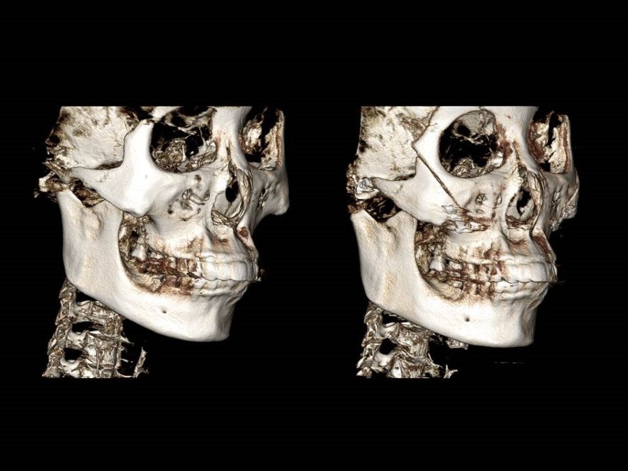 Zygoma Reduction Surgery Through Complete Osteotomy of the Body and Arch image 20