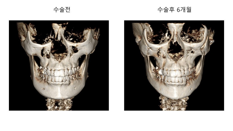 안면윤곽 수술전과 후의 증례 고찰 관련 이미지 1