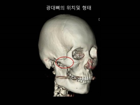 옆광대 축소를 위한 효과적인 방법 관련 이미지 1