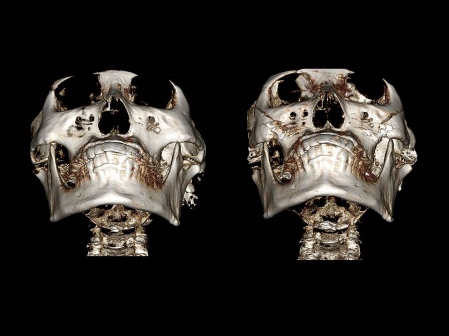 Zygoma Reduction Surgery Through Complete Osteotomy of the Body and Arch image 15