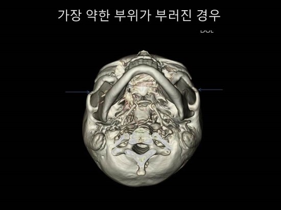 광대뼈축소성형술과 재수술을 생각하는 경우 관련 이미지 3