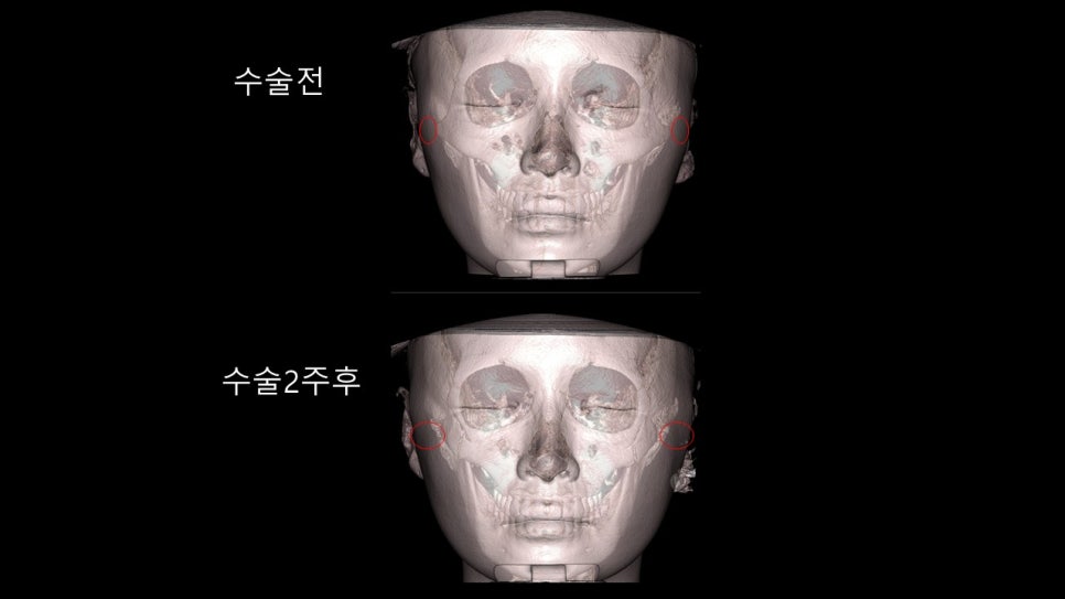 안면윤곽수술후 모습이 바뀌어 보이려면 얼마나 기다려야 할까? "윤곽수술과 술후 다운타임및 술후 관리방법" 관련 이미지 38