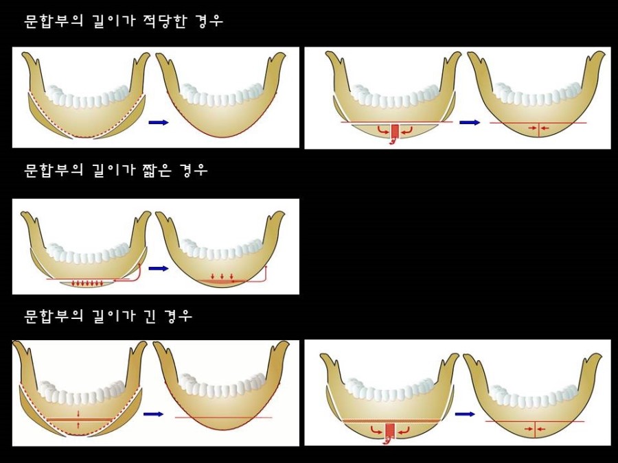 Reduction Mandibular Contouring for V-line Lower Facial contour 관련 이미지 1