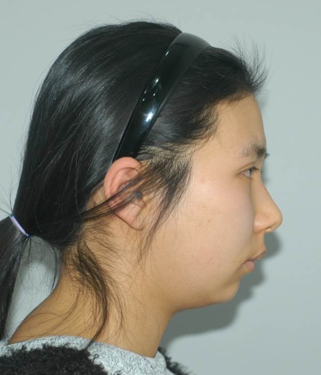 Double Chin Liposuction image 4