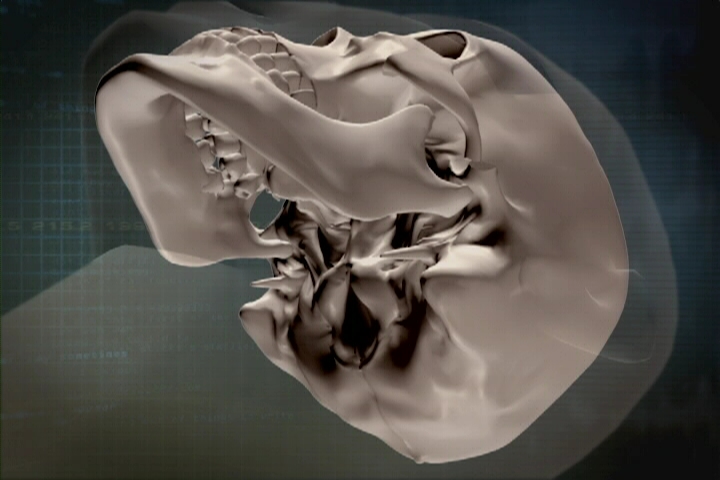 Understanding the Structure of the Cheekbone and Cheekbone Reduction Surgery image 20