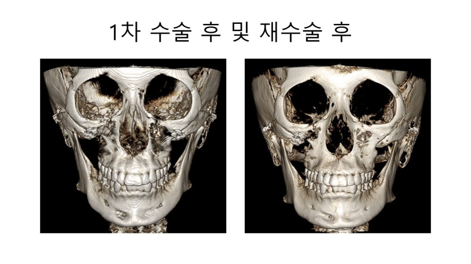 광대뼈 축소성형술 - 수술방법에 따른 모습변화의 차이 관련 이미지 4