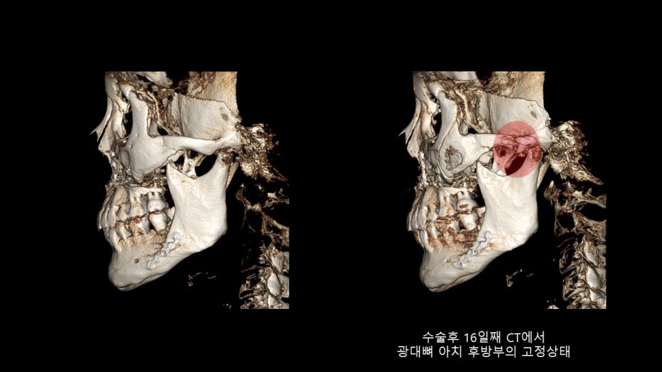 광대뼈축소성형술 증례 리뷰 -1 관련 이미지 15