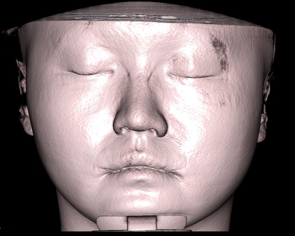 How Is Face Shape Determined? Factors That Determine Face Shape and Facial Contouring Surgery image 1