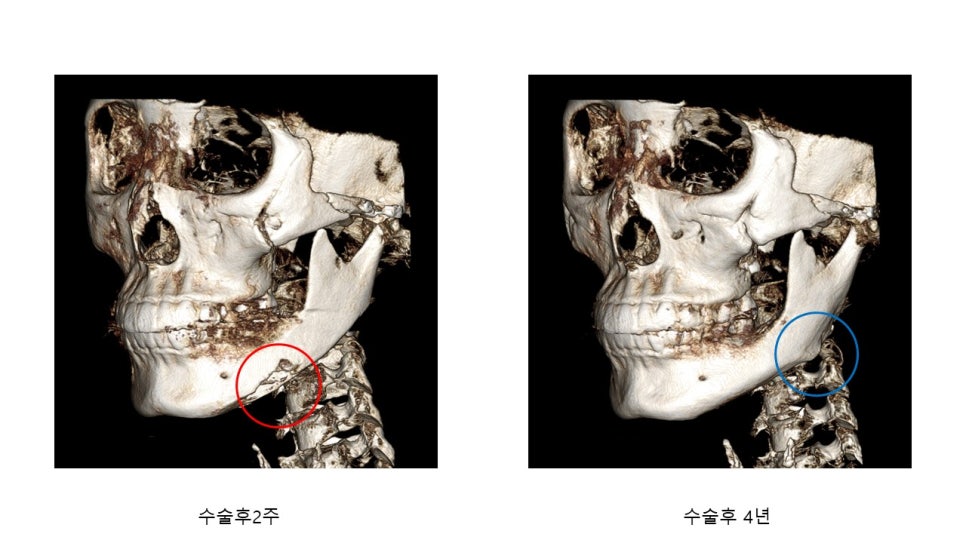 사각턱 수술후 시기에 따른 아랫턱뼈의 형태변화 관련 이미지 23