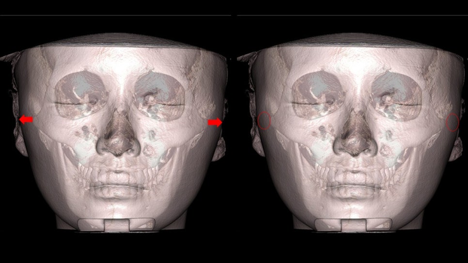 How Is Face Shape Determined? Factors That Determine Face Shape and Facial Contouring Surgery image 19