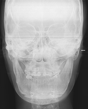 V-Line Square Jaw Revision Surgery image 1
