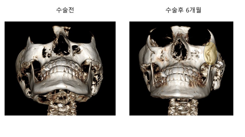 안면윤곽 수술전과 후의 증례 고찰 관련 이미지 10