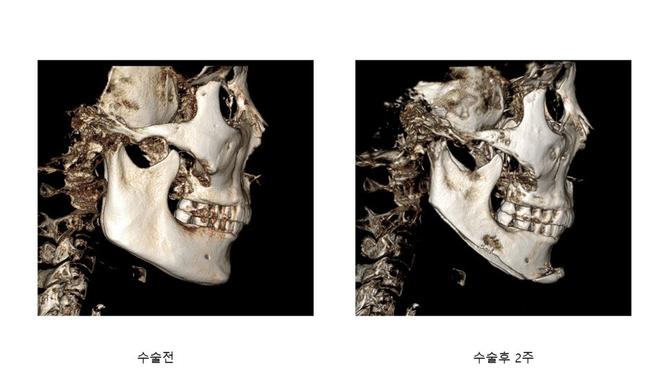 사각턱 수술후 시기에 따른 아랫턱뼈의 형태변화 관련 이미지 17