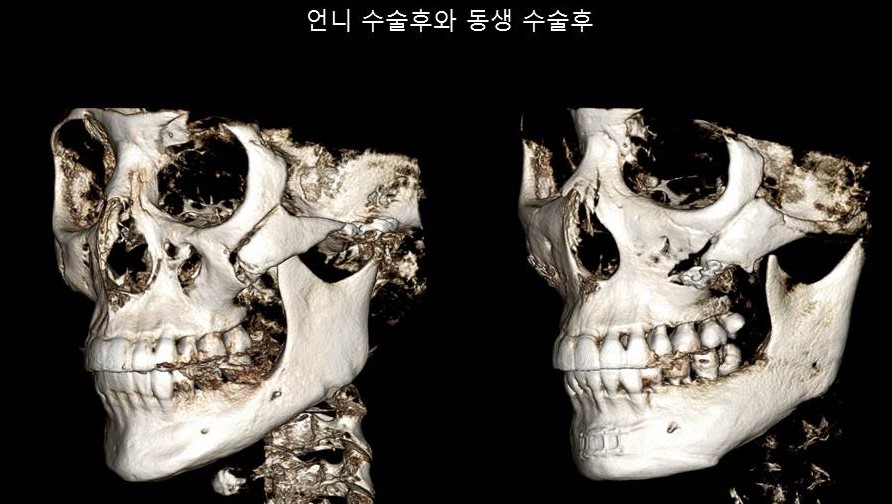 Understanding Square Jaw Surgery - Comparison of Postoperative Results Between Biological Sisters Who Underwent Surgery Using Different Methods image 9