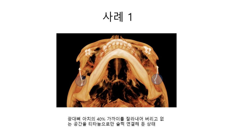 A Zygomatic Surgery Outcome That Makes Anger Surge image 6