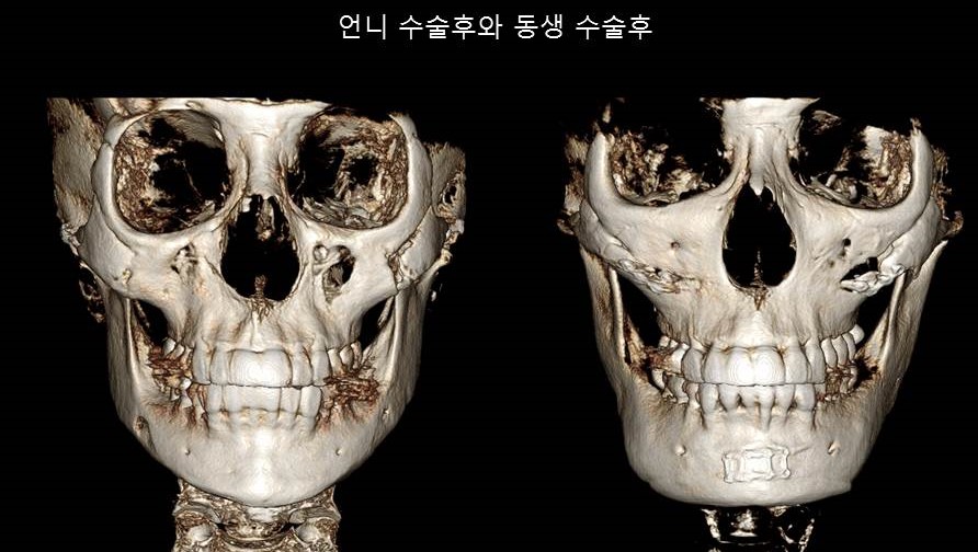 Understanding Square Jaw Surgery - Comparison of Postoperative Results Between Biological Sisters Who Underwent Surgery Using Different Methods image 6