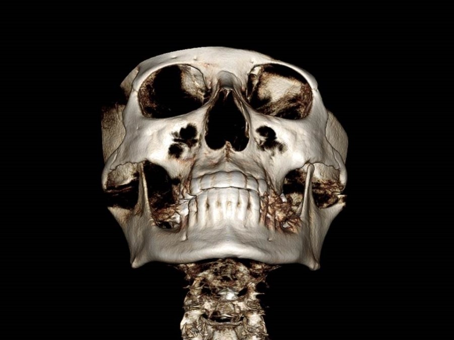 Understanding the Structure of the Cheekbone and Cheekbone Reduction Surgery image 6