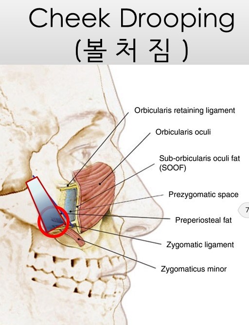 광대뼈축소성형술 - 볼처짐의 원인에 관한 이해 관련 이미지 4