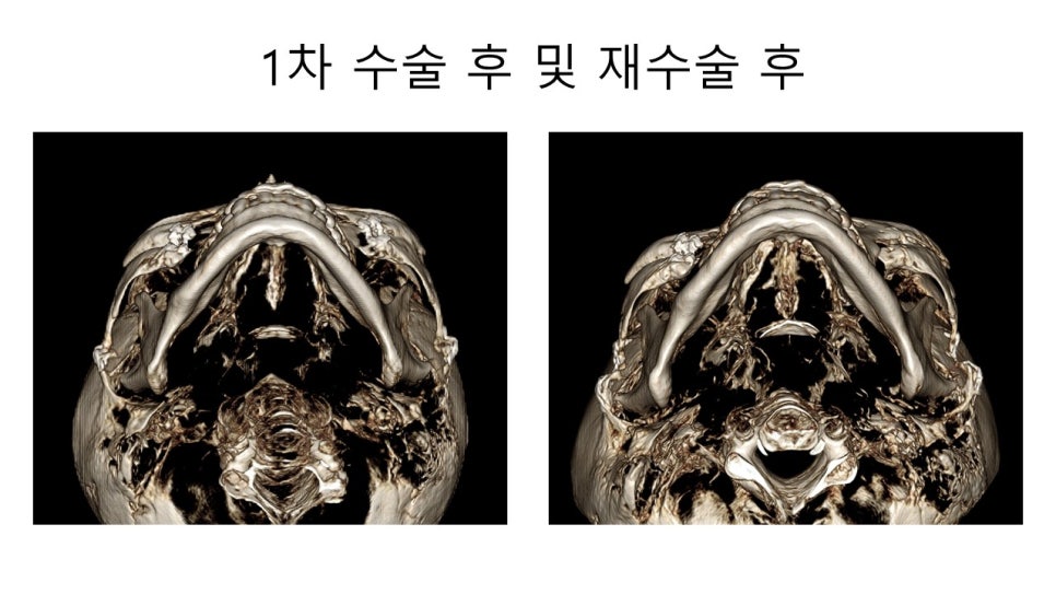 광대뼈 축소성형술 - 수술방법에 따른 모습변화의 차이 관련 이미지 8