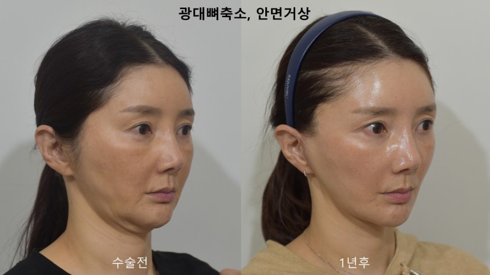 "윤곽거상 수술 " 실제 사례 소개 관련 이미지 3