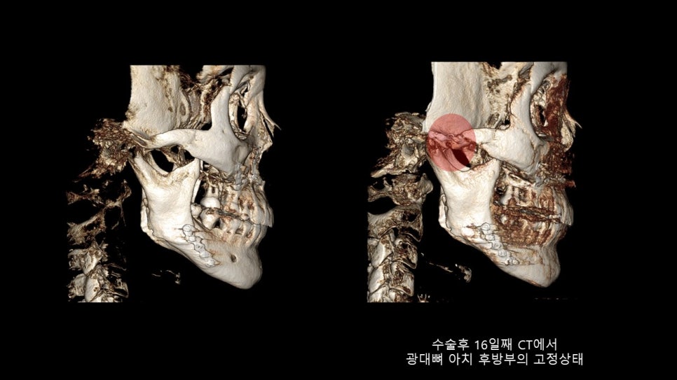 광대뼈축소성형술 증례 리뷰 -1 관련 이미지 16