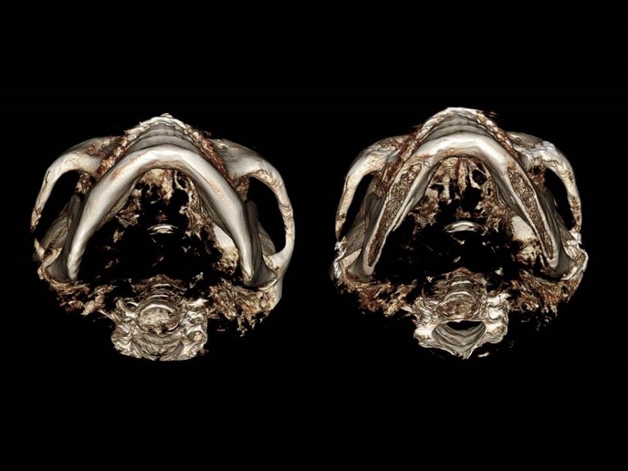 Zygoma Reduction Surgery Through Complete Osteotomy of the Body and Arch image 9