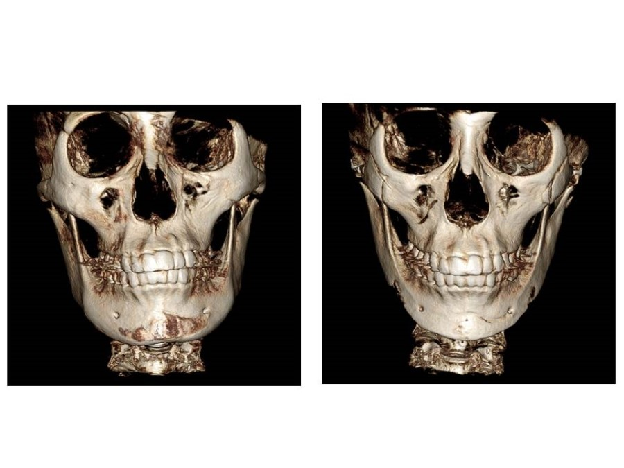 V-Line Square Jaw Surgery - The Appropriate Surgical Method According to the Shape of the Chin image 13