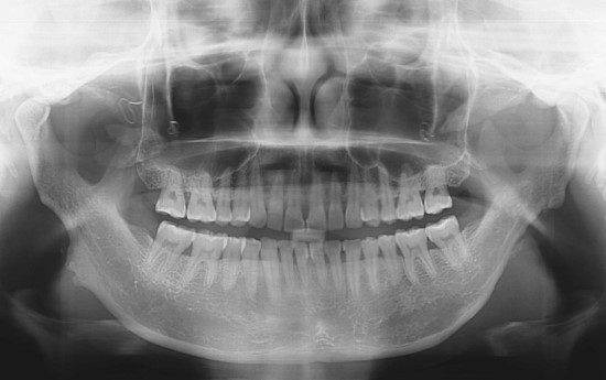 V-Line Square Jaw Revision Surgery image 7