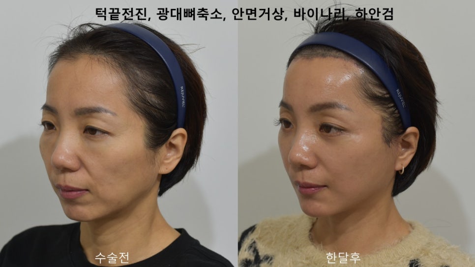 "윤곽거상 수술 " 실제 사례 소개 관련 이미지 10