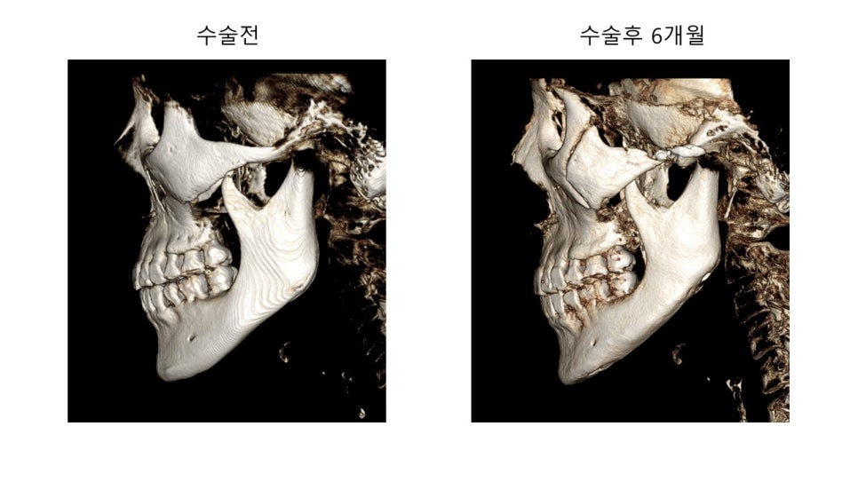 안면윤곽 수술전과 후의 증례 고찰 관련 이미지 7