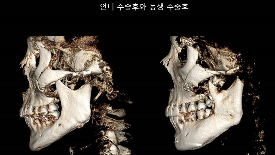 Understanding Square Jaw Surgery - Comparison of Postoperative Results Between Biological Sisters Who Underwent Surgery Using Different Methods image 10