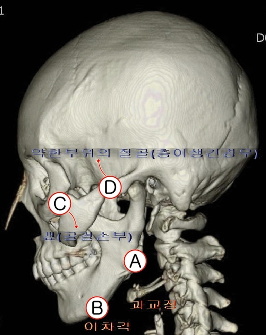 Pitfalls of Cheekbone Reduction Surgery Depending on the Method image 6