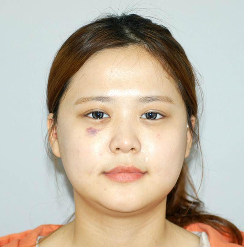 Progress After Facial Contouring Surgery 1 - Zygoma Reduction Surgery and Square Jaw Surgery image 2