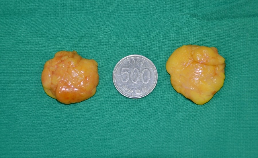 The Amount of Deep Buccal Fat Removed During Deep Buccal Fat Removal image 7