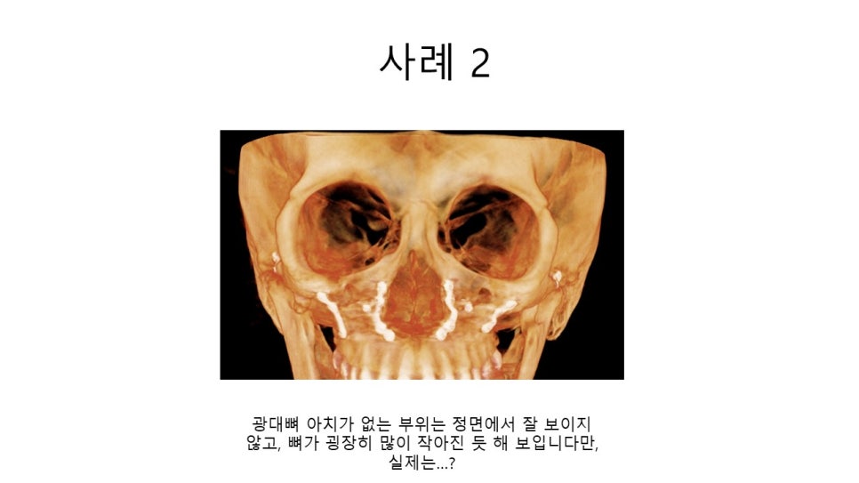 A Zygomatic Surgery Outcome That Makes Anger Surge image 15