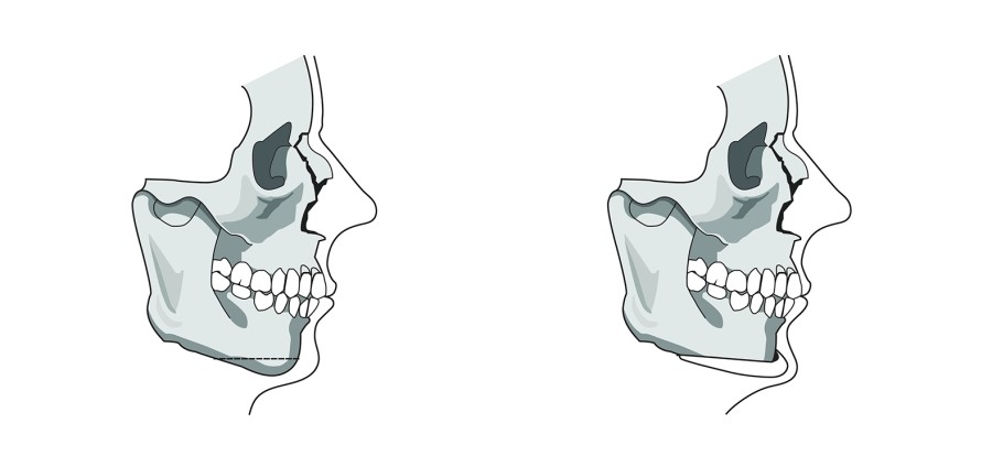 Overall Information About Chin Surgery for a Receded Chin image 2
