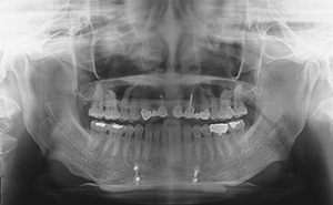 V-Line Square Jaw Revision Surgery image 3