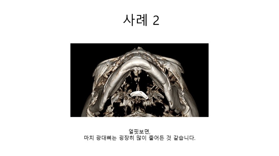 A Zygomatic Surgery Outcome That Makes Anger Surge image 11