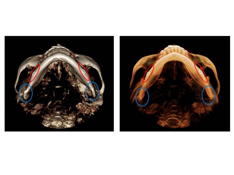 Proper Understanding of Cortical Bone Resection or Cortical Bone Reduction in Square Jaw Surgery image 1