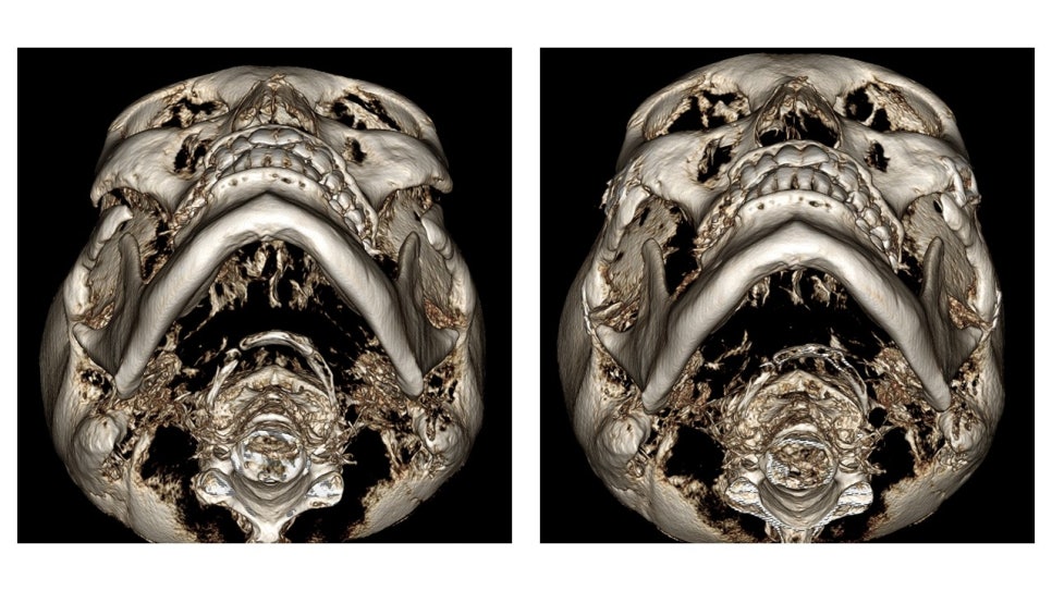 Why Cheekbone Revision Surgery for Sagging Cheeks and Nonunion 30 Years After Cheekbone Surgery Succeeded After a Facelift image 6
