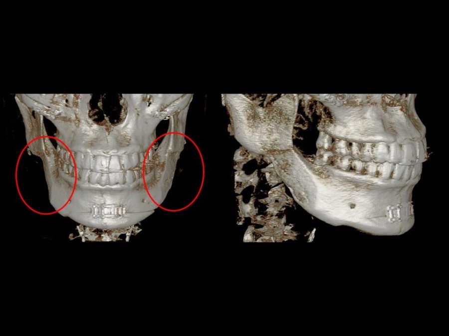 Cortical Bone Resection and Cortical Bone Trimming in Square Jaw Surgery image 2