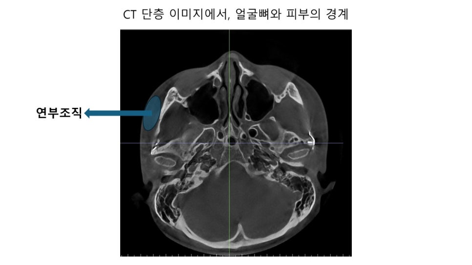 얼굴 윤곽에 있어서 연부조직의 중요성 - 윤곽주사, 레인보우 주사 관련 이미지 4