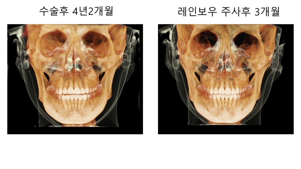 얼굴 윤곽에 있어서 연부조직의 중요성 - 윤곽주사, 레인보우 주사 관련 이미지 8
