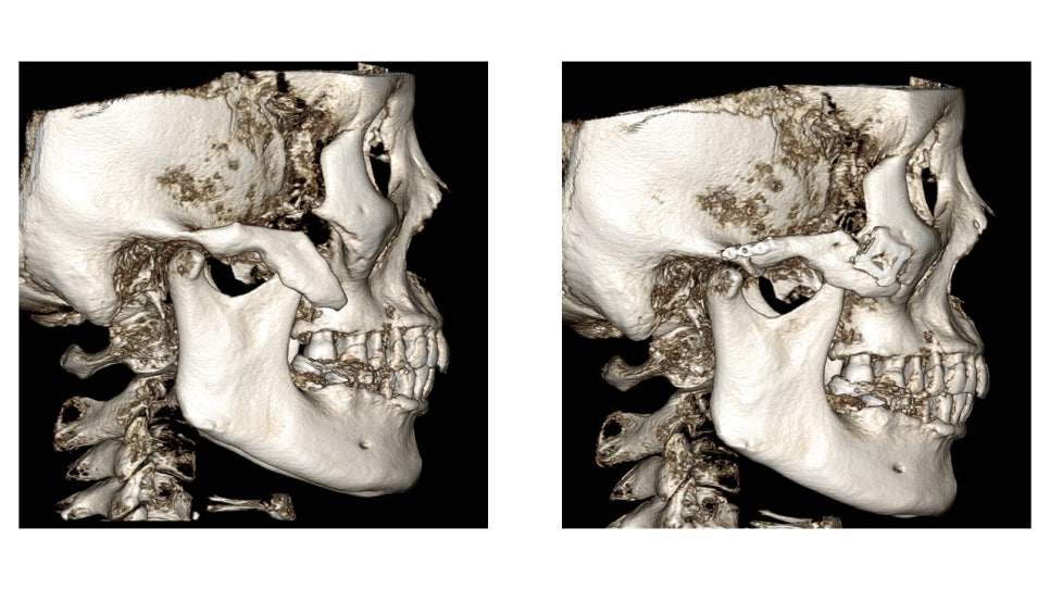 Why Cheekbone Revision Surgery for Sagging Cheeks and Nonunion 30 Years After Cheekbone Surgery Succeeded After a Facelift image 7
