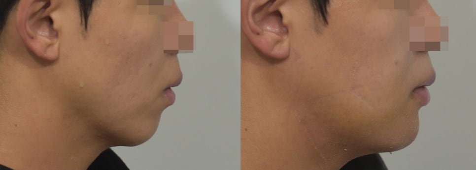 입체적인 옆라인의 완성, 무턱과 이중턱을 동시에 해결하는 방법 관련 이미지 28