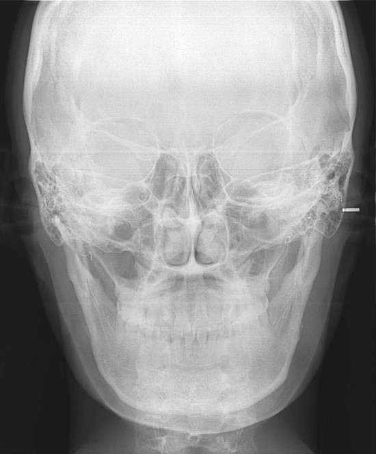 V-Line Square Jaw Revision Surgery image 5