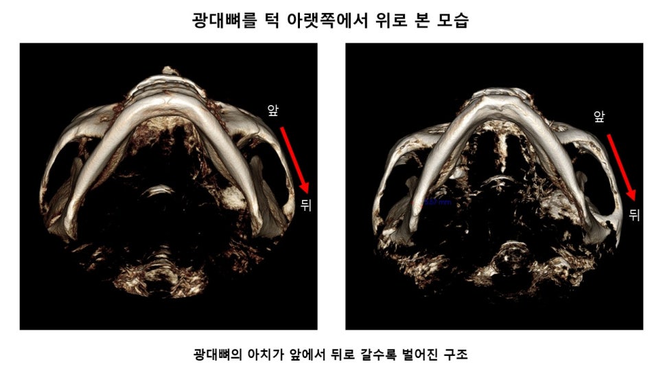 후방광대, 뒷광대 축소에 관한 그릇된 정보와 정확한 이해 관련 이미지 1