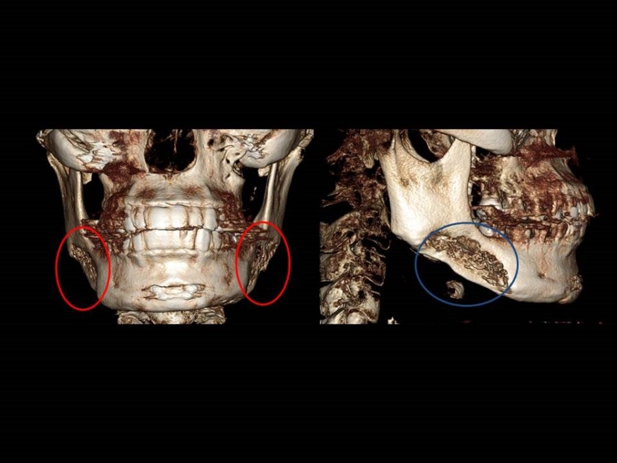 Cortical Bone Resection and Cortical Bone Trimming in Square Jaw Surgery image 1