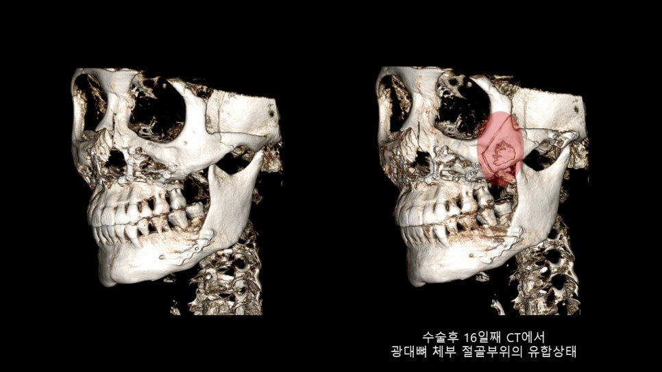 광대뼈축소성형술 증례 리뷰 -1 관련 이미지 13